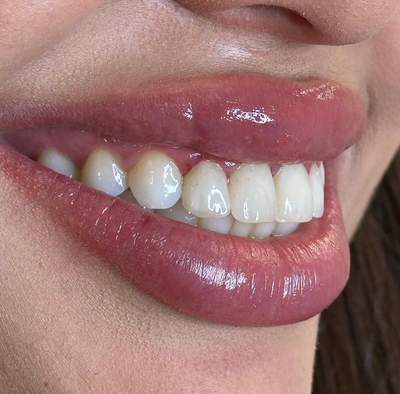 Clareamento Dental