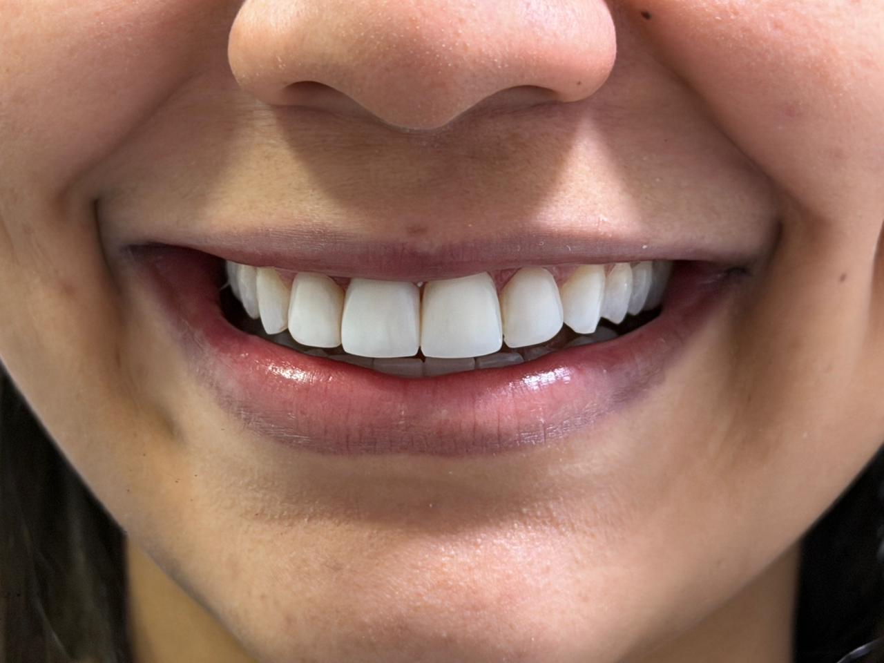 Lentes de Contato Dental